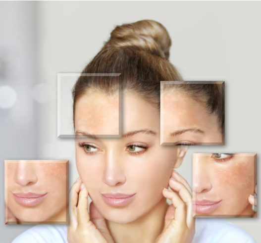 Tips for Treating Hyperpigmented Skin