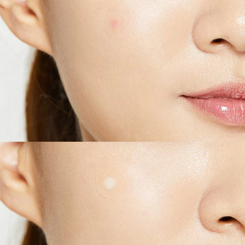 [COSRX] Acne Pimple Master Patch